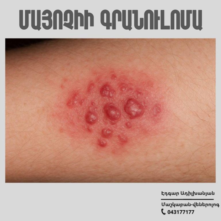 Մայոչիի գրանուլոման